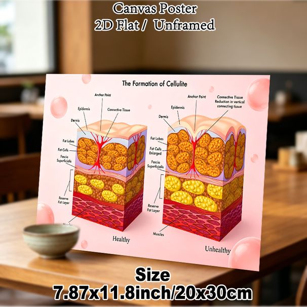 Cellulite Formation Anatomical Painting Poster, Informative Medical Illustration Poster, Clear Comparison Of Healthy & Unhealthy Skin Structures_maomaolike.com