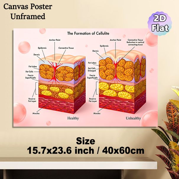 Cellulite Formation Anatomical Painting Poster, Informative Medical Illustration Poster, Clear Comparison Of Healthy & Unhealthy Skin Structures_maomaolike.com